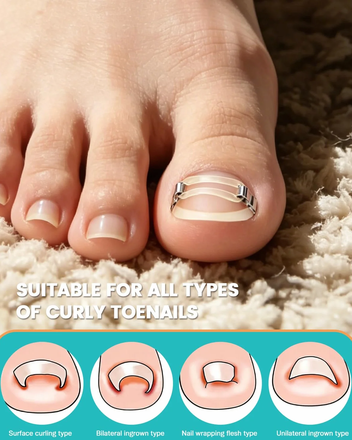 BEZOX Correcteur d'ongles incarnés application facile maison