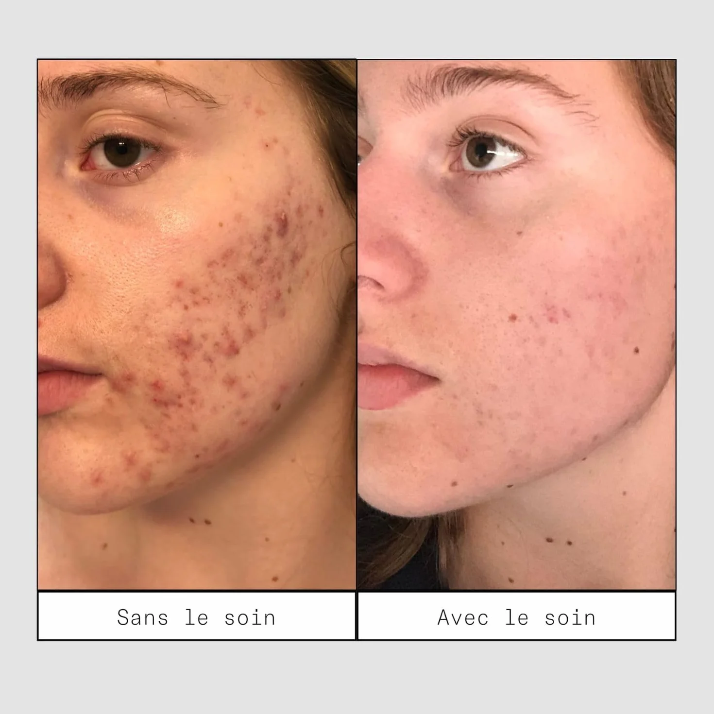 Skin & Out Soin Boutons Traitement ciblé Acide Salicylique 1% Bakuchiol 99% Naturel