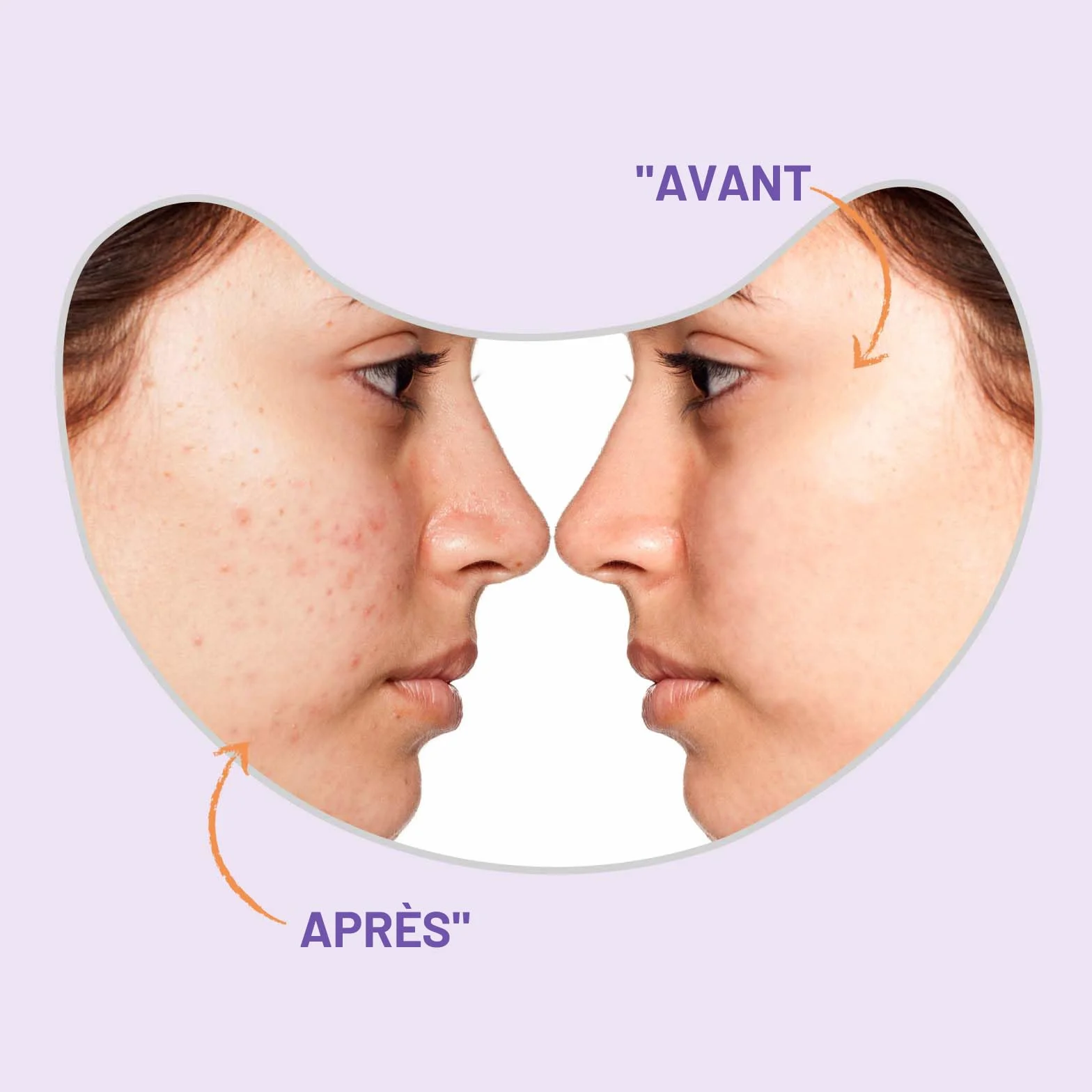 Patchs bouton ACOTYE 32pcs, pimple patch à l'huile d'arbre à thé, acide salicylique et niacinamide