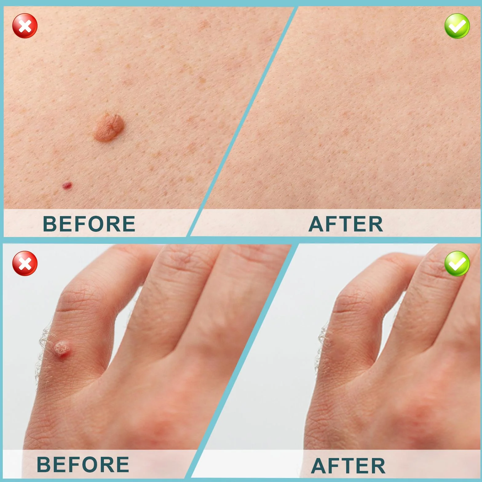 Skin Tag Remover 30ml, Fluide de Soin pour Peau Mains et Pieds, Peau Lisse