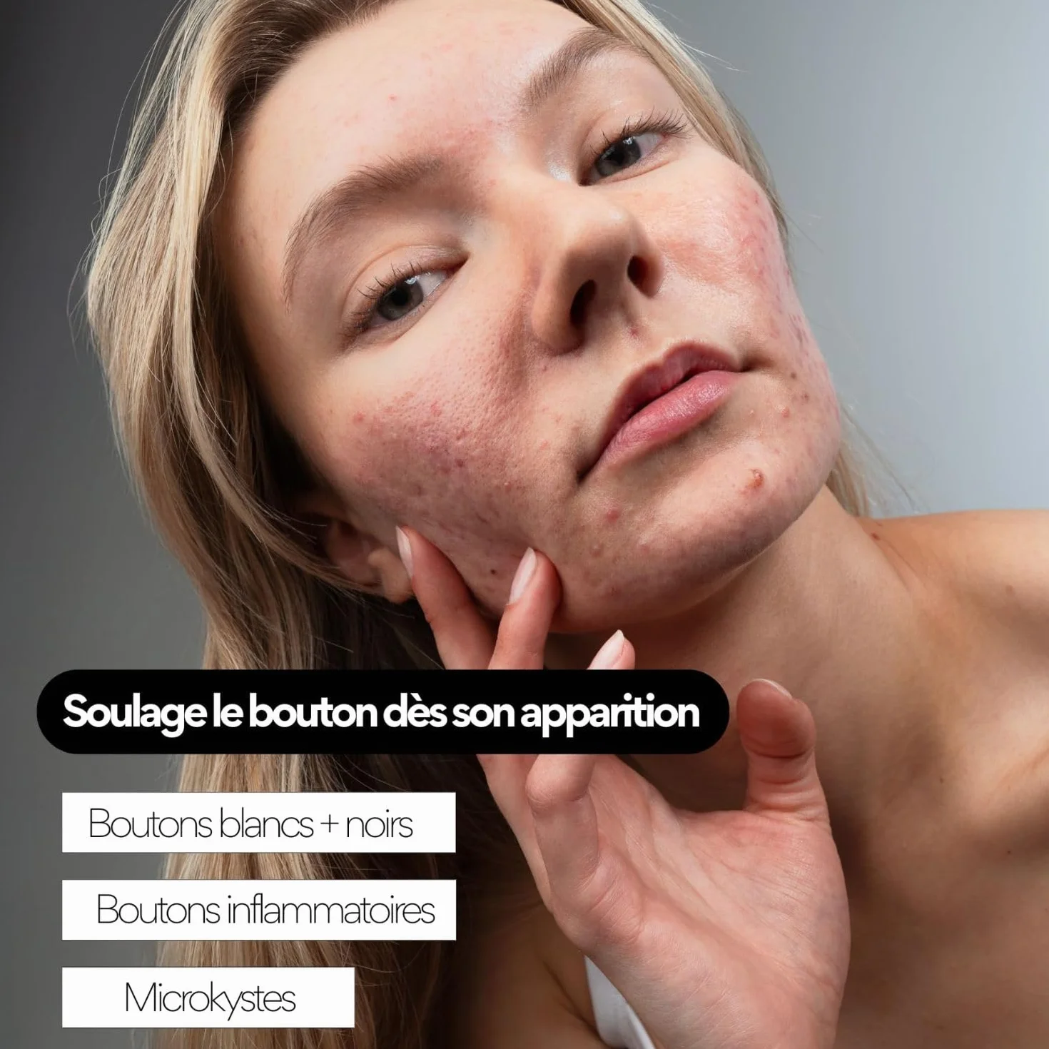 Skin & Out Soin Boutons Traitement ciblé Acide Salicylique 1% Bakuchiol 99% Naturel