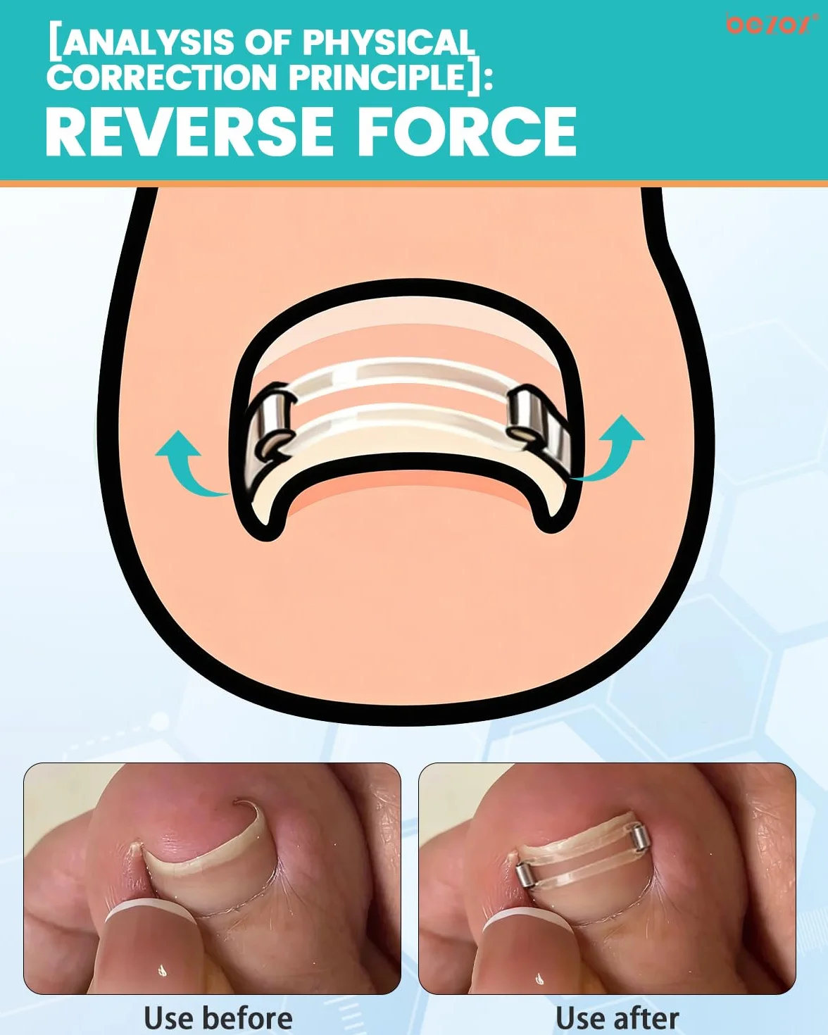 BEZOX Correcteur d'ongles incarnés application facile maison