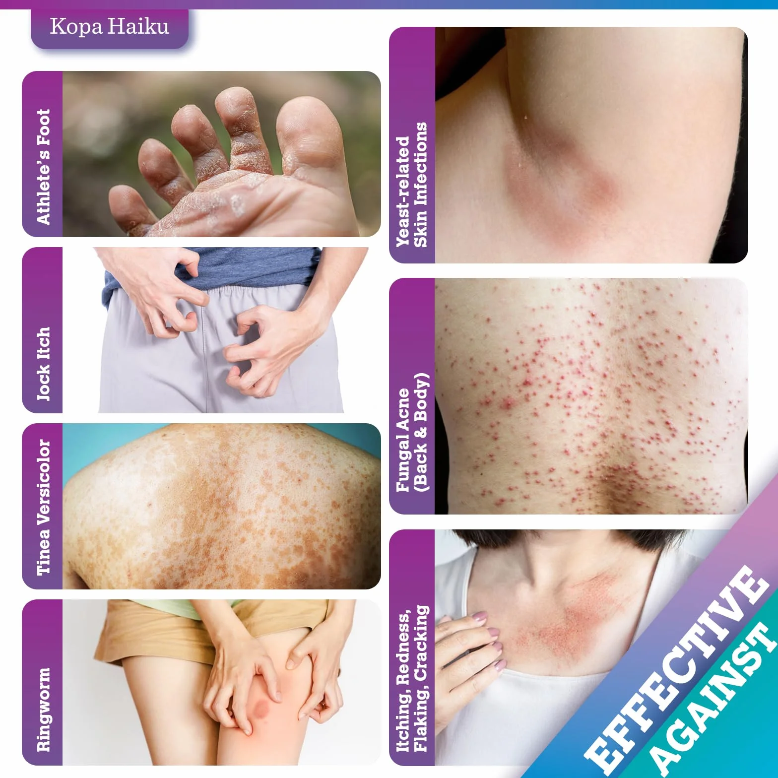 Crème Antifongique Pied Mycose Peau: Soin Topique Pityriasis Versicolor pour Pied, Aine, Aisselle