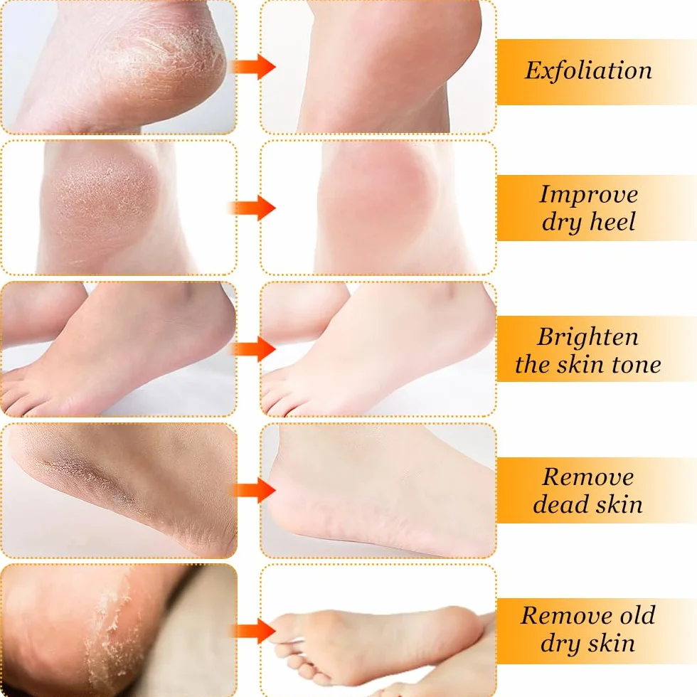 Spray anti callosités des pieds, exfoliant hydratant nourrissant pour pieds secs