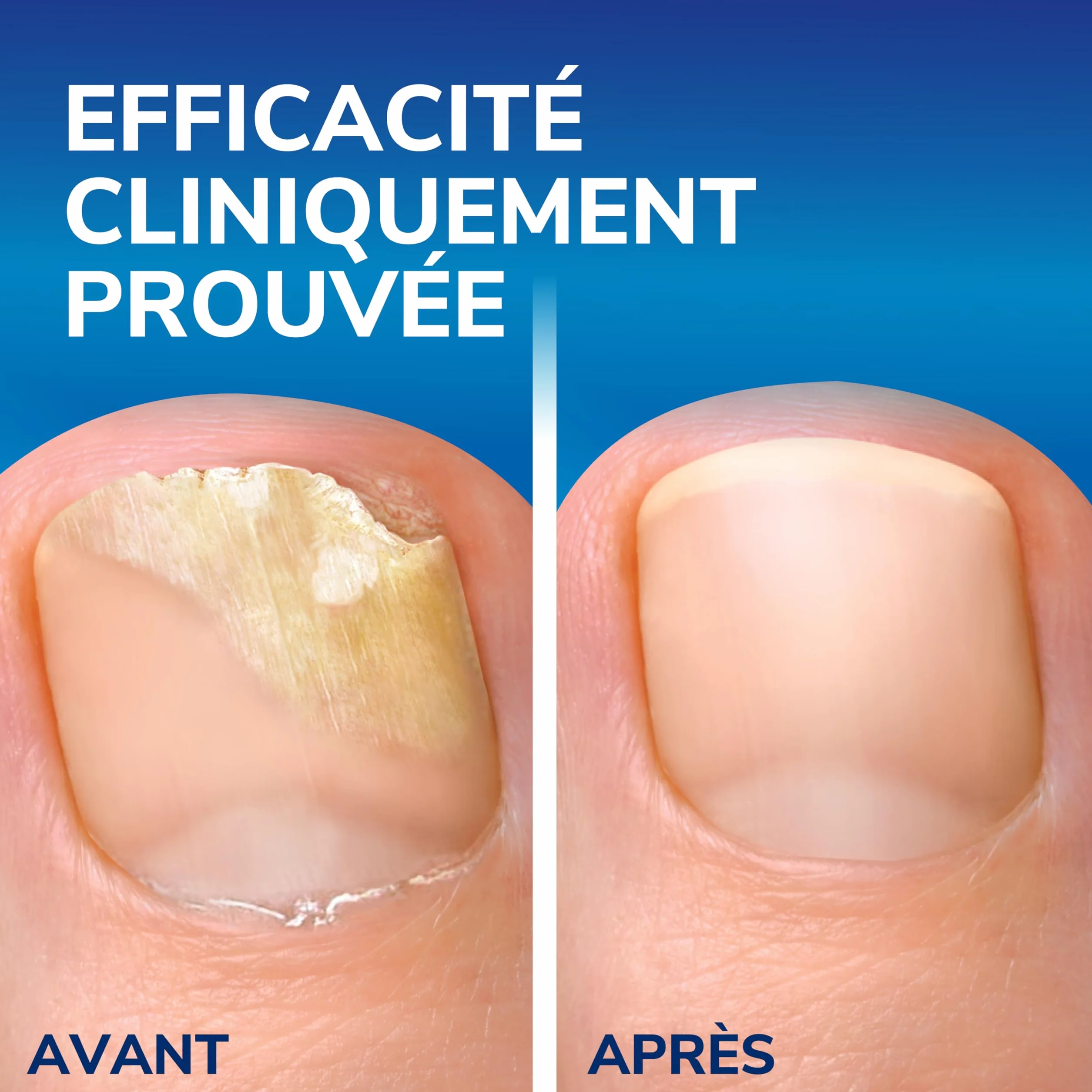 Dr. Scholl's Mycose des ongles 2-en-1 Traitement et Protection 3,8 mL