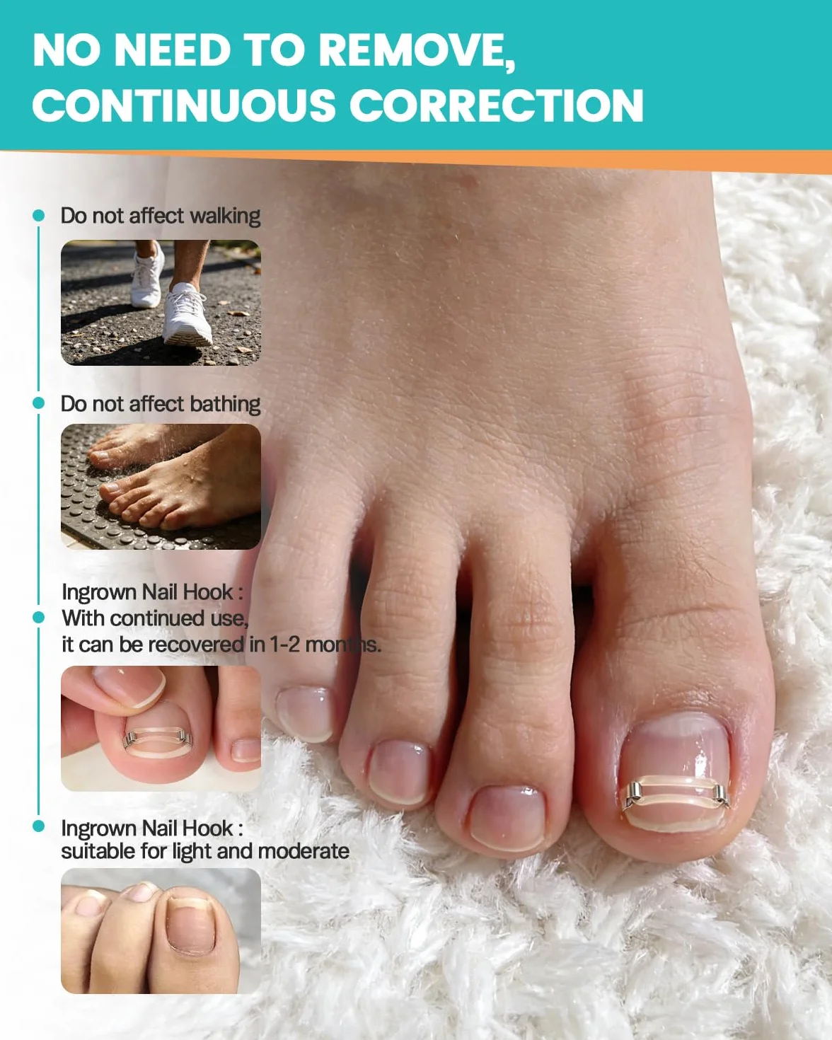 BEZOX Correcteur d'ongles incarnés application facile maison