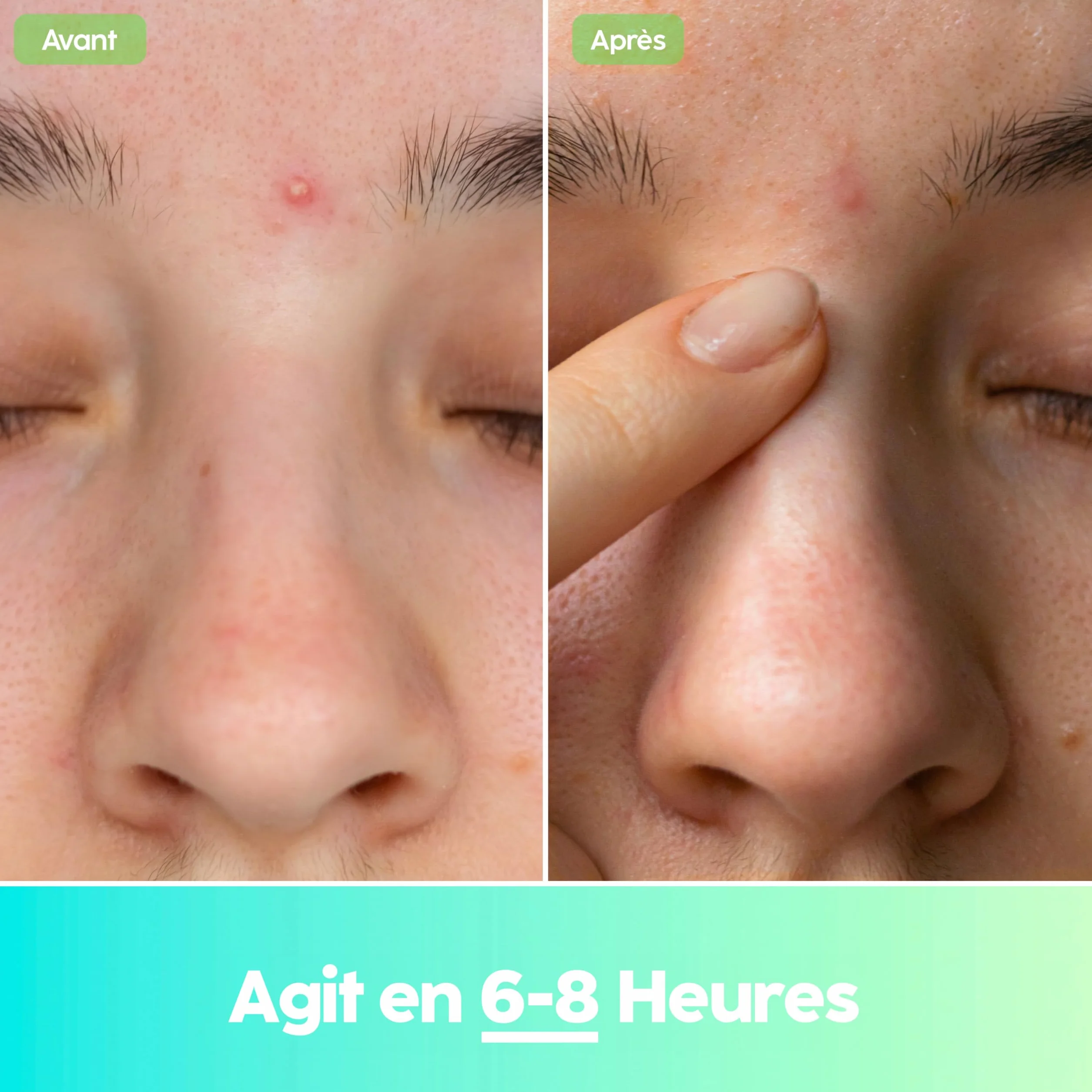 Patch Boutons Hydrocolloïde Coréen Anti-Acné Invisibles 102 Unités 2 Tailles Végétalien