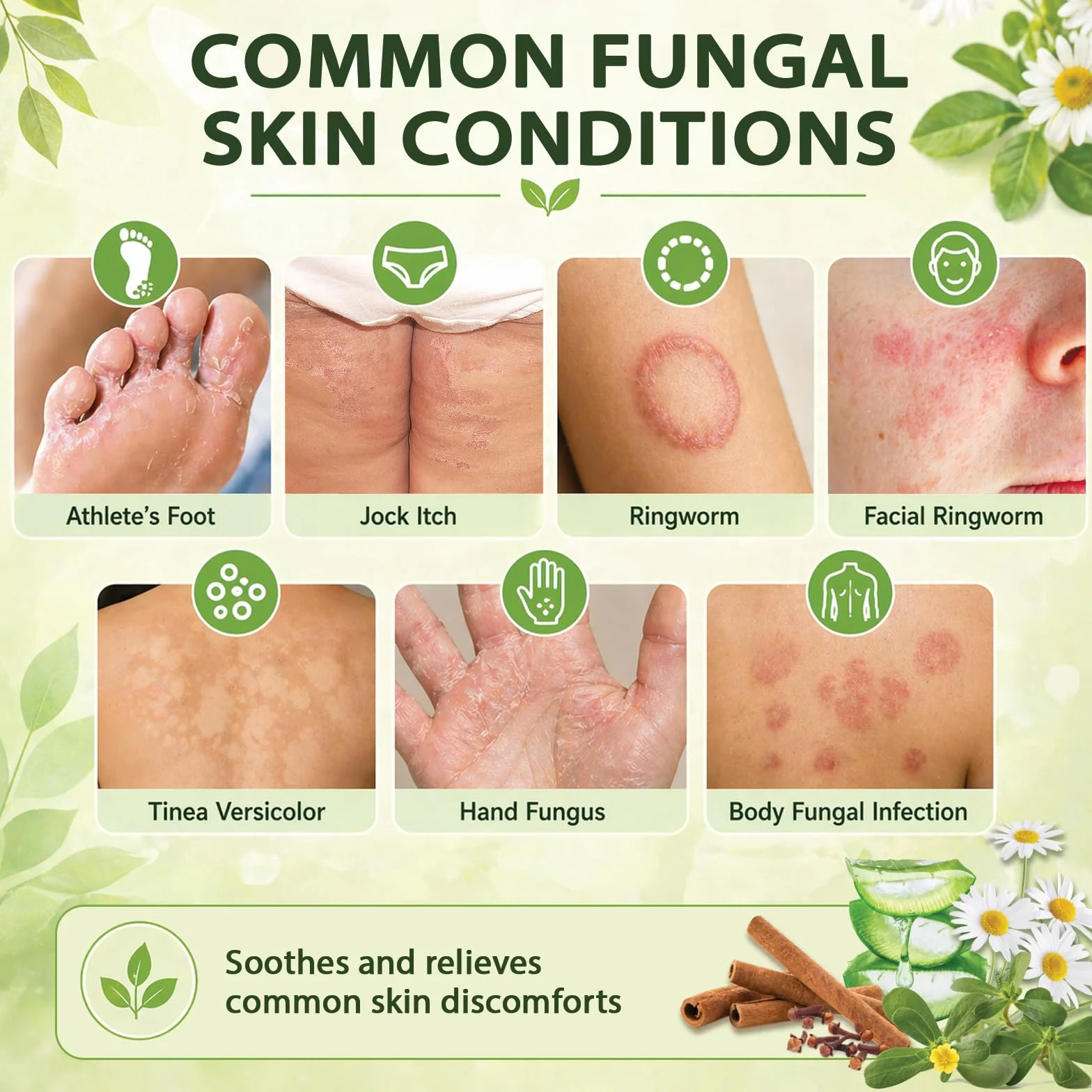 Crème Antifongique Mycose Pied Traitement Peaux Sujettes Démangeaisons Pied d’Athlète Inconforts Aine Pityriasis Versicolor Teigne Sans Stéroïde
