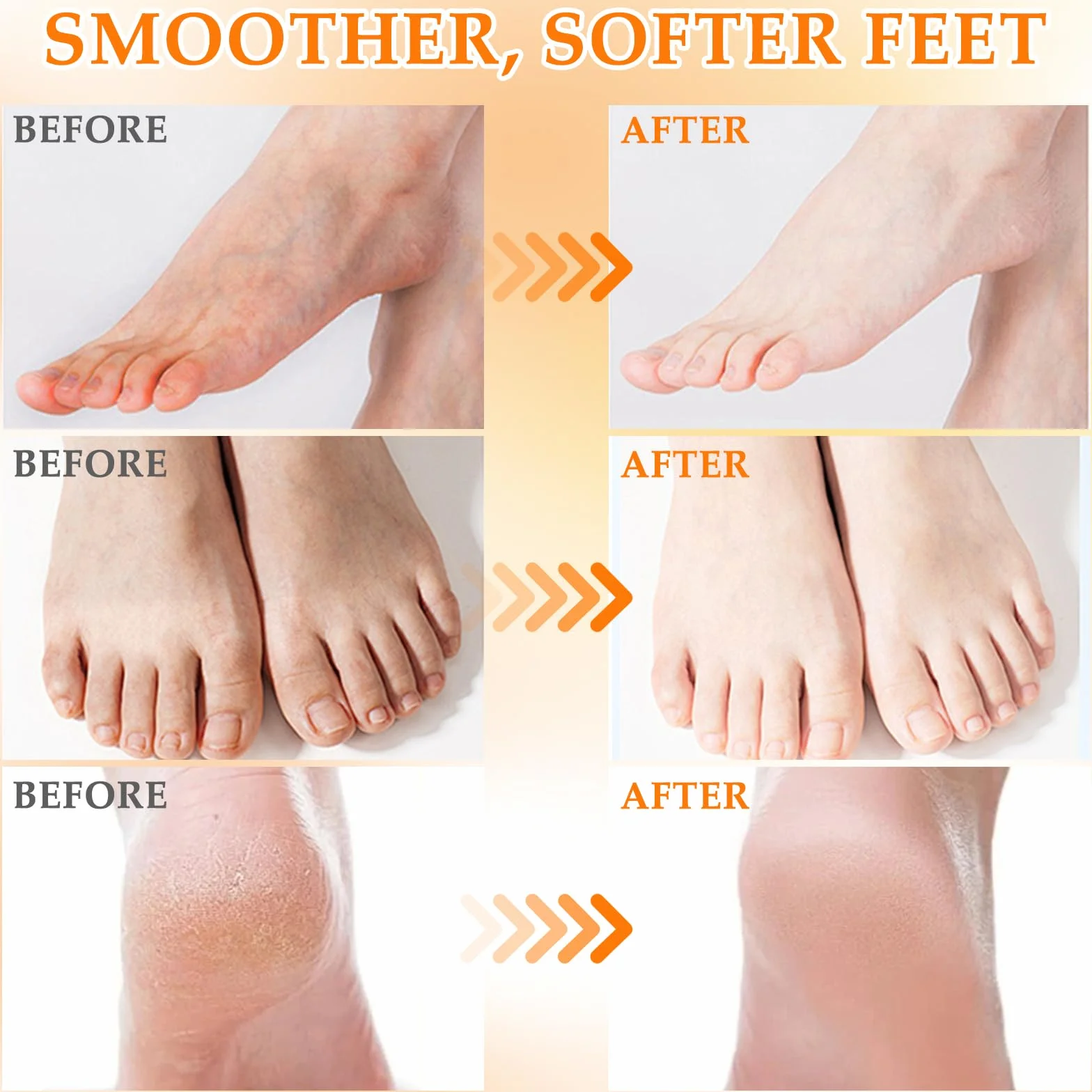Masque Pied Exfoliant 6 Paires – Chaussettes Exfoliantes Anti-Cornes Coco Fraise Miel Soin des Pieds Doux Talons Secs Crevassés Hydratant