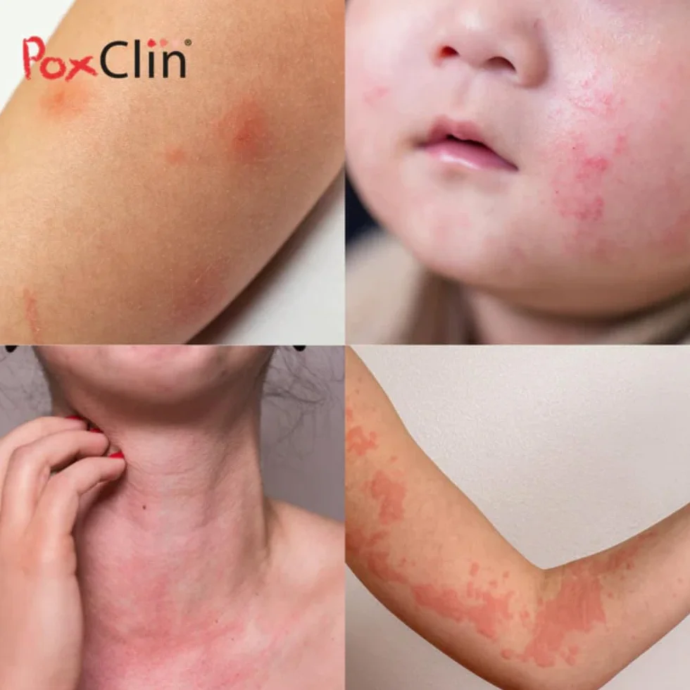 PoxClin Démangeaisons Mousse Anti-Démangeaisons 100 ml Eczéma Urticaire Piqûres Insectes Coup Soleil Visage Corps
