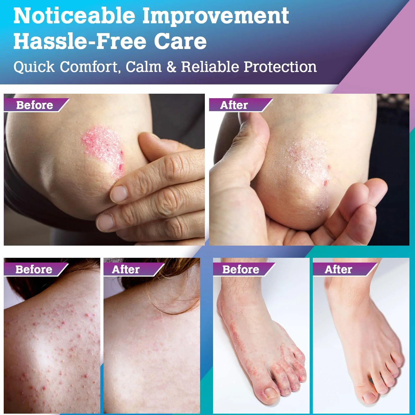 Crème Antifongique Pied Mycose Peau: Soin Topique Pityriasis Versicolor pour Pied, Aine, Aisselle
