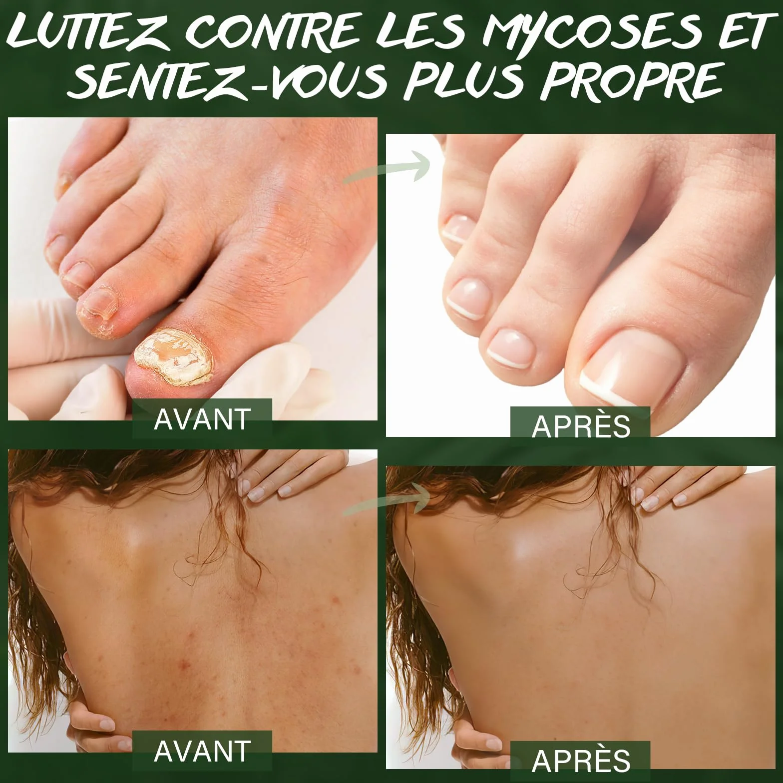 Gommage Corporel à l'Huile d'Arbre à Thé 360g – Exfoliant au Sel Marin pour Mycoses, Démangeaisons, Eczéma