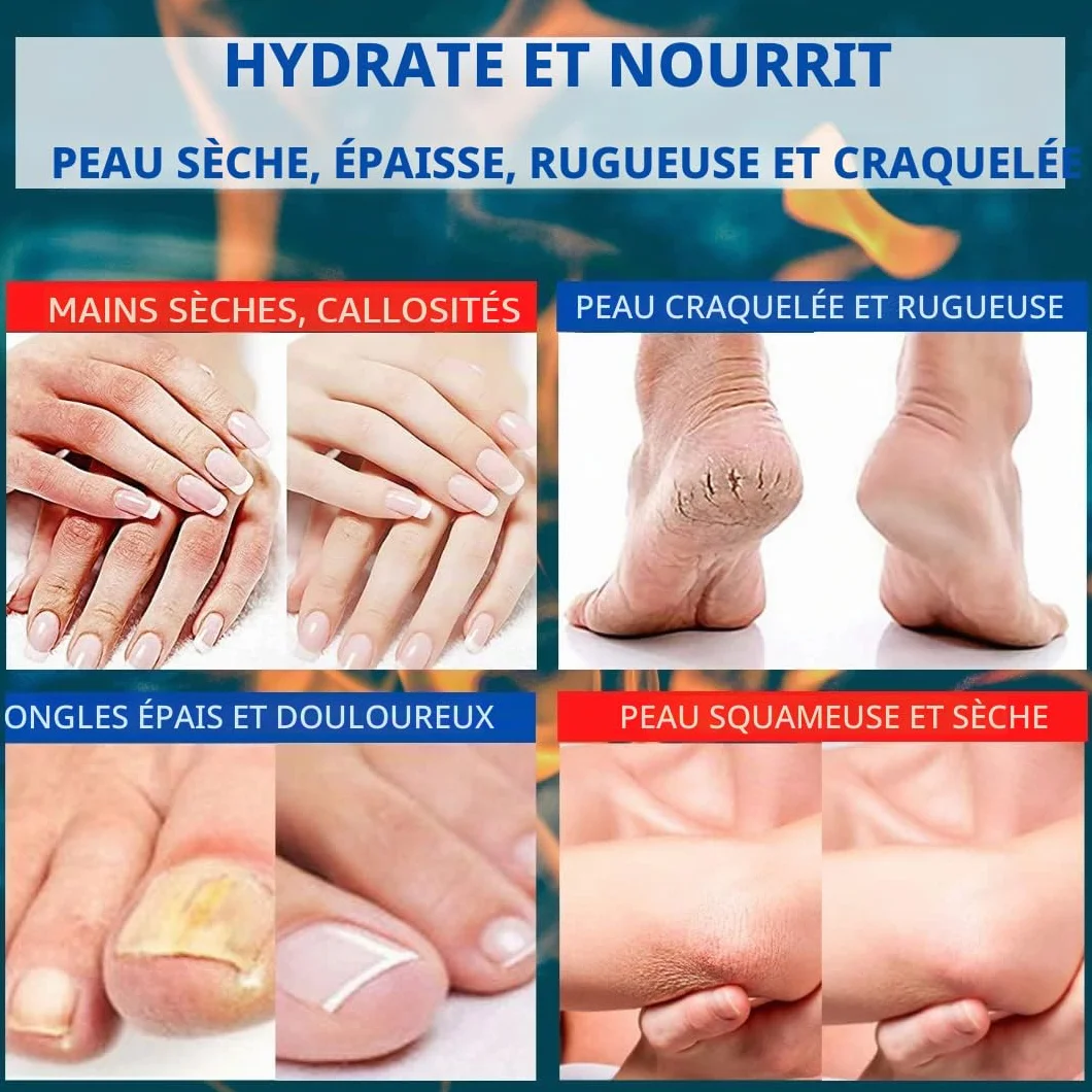 Crème D'Urée 30% - Élimine Cicatrices, Eczéma, Kératose, Psoriasis, Peaux Sèches, Acide Lactique AHA