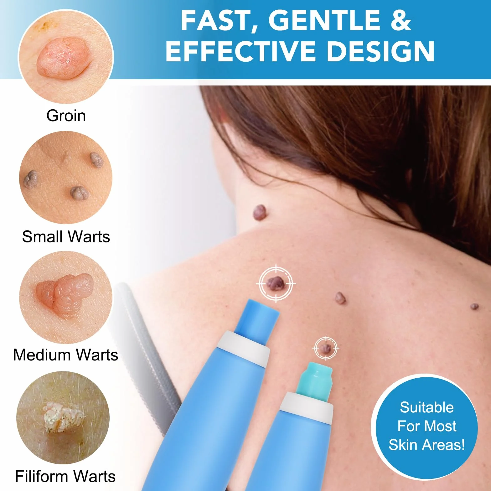 Kit de Traitement Acrochordons, Stylo d'Élimination Automatique 2 Tailles, Efficace et Indolore – Verrues et Grains de Beauté 2-8mm