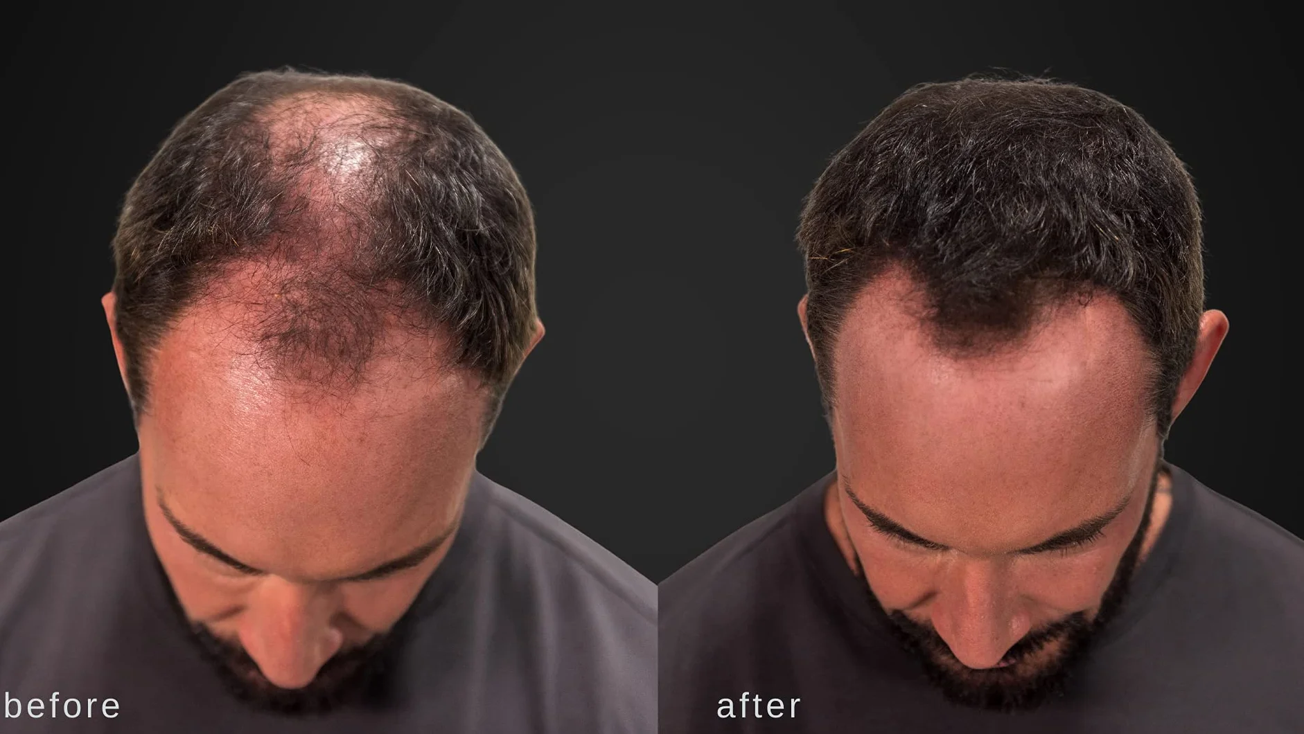 Hypoallergénique fibres épaississantes cheveux Marron foncé testé dermatologues