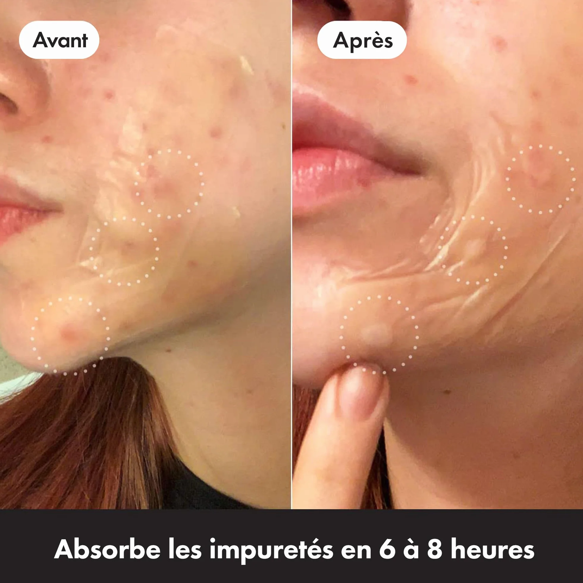 Hero Mighty Patch Surface: Patch anti-acné XL à l'Hydrocolloïde, 10 patchs