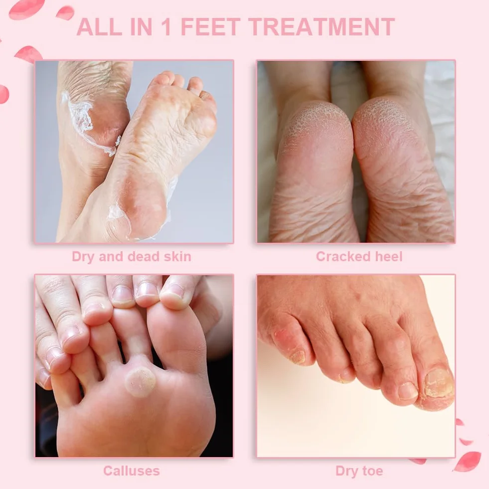 Masque Pieds Peeling Exfoliant 4 Paires Hydratant Rose Chaussette Exfoliante Nourrissant Callosités Crevasses Pieds Secs