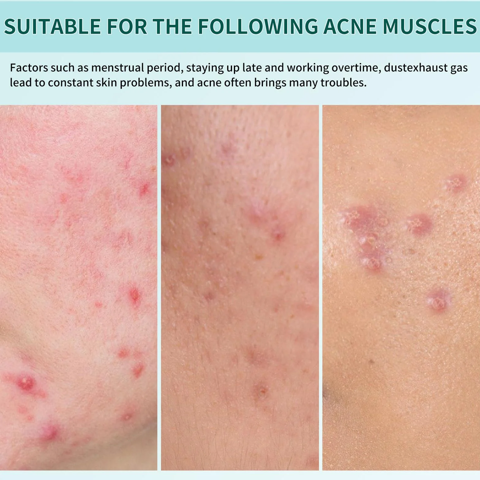Patch Boutons Acne 360 Pièces, 3 Tailles Pimple Patch Star avec Huile Tea Tree et Acide Salicylique, Hydrocolloïdes Imperméables