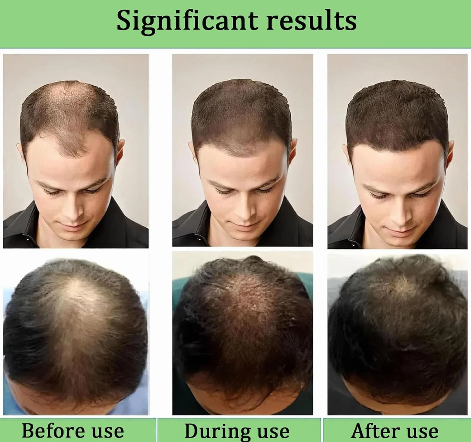 Alphainfuse Système de repousse des cheveux, sérum micro-aiguilles croissance cheveux, traitement renforce racines (1PC)