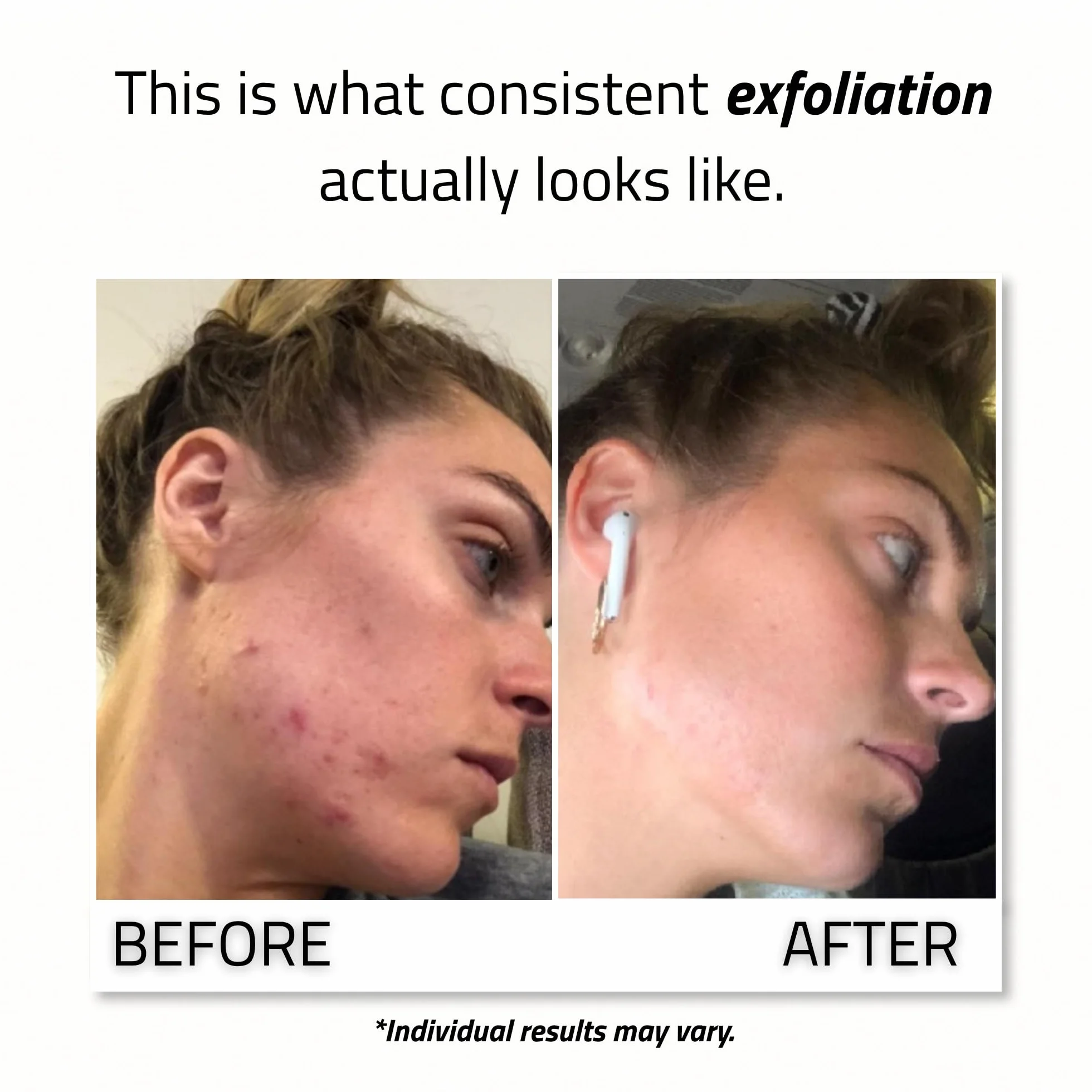 YEOUTH Acide Glycolique Peeling Visage 30% avec Rétinol et Thé Vert, Exfoliant Chimique 30ml