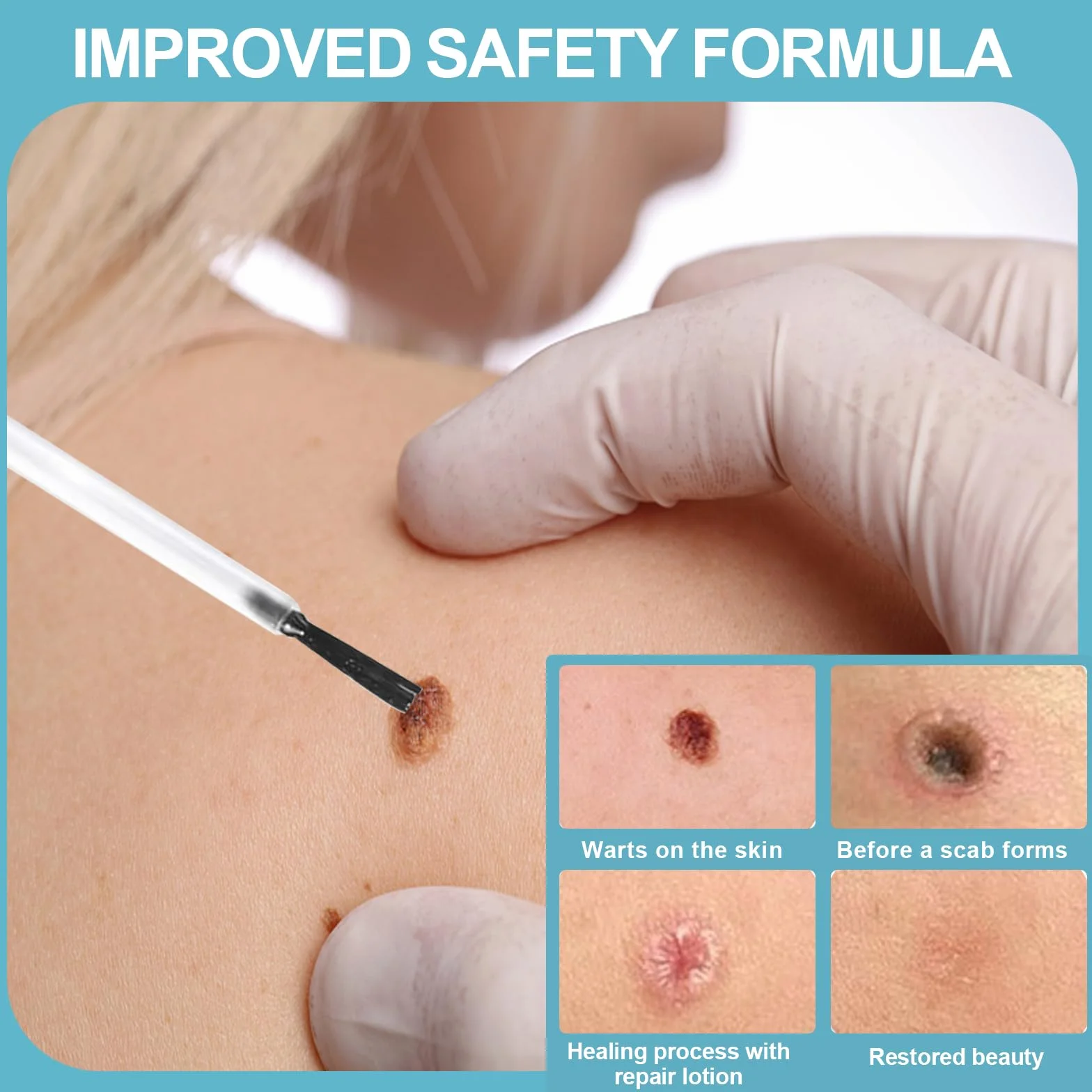Skin Tag Remover 30ml, Fluide de Soin pour Peau Mains et Pieds, Peau Lisse
