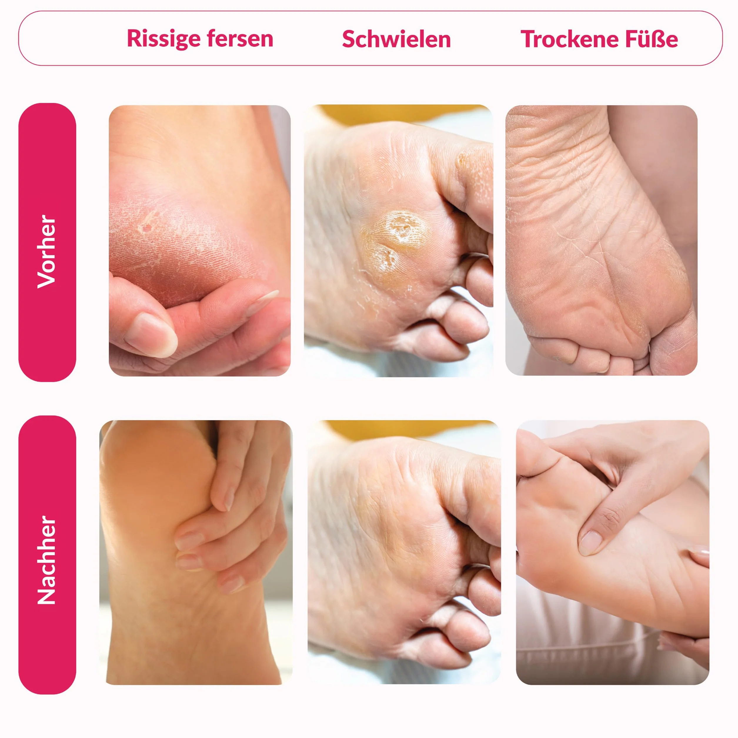 Chaussettes anti-callosités premium 2 paires - Masque pour callosités - Soins des pieds efficaces