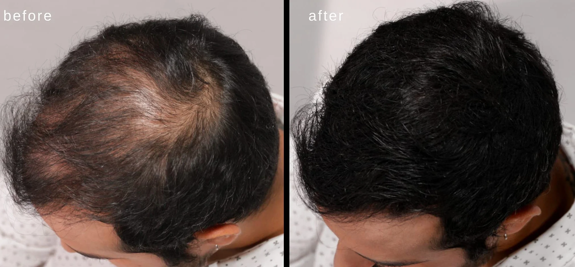 Hypoallergénique fibres épaississantes cheveux Marron foncé testé dermatologues