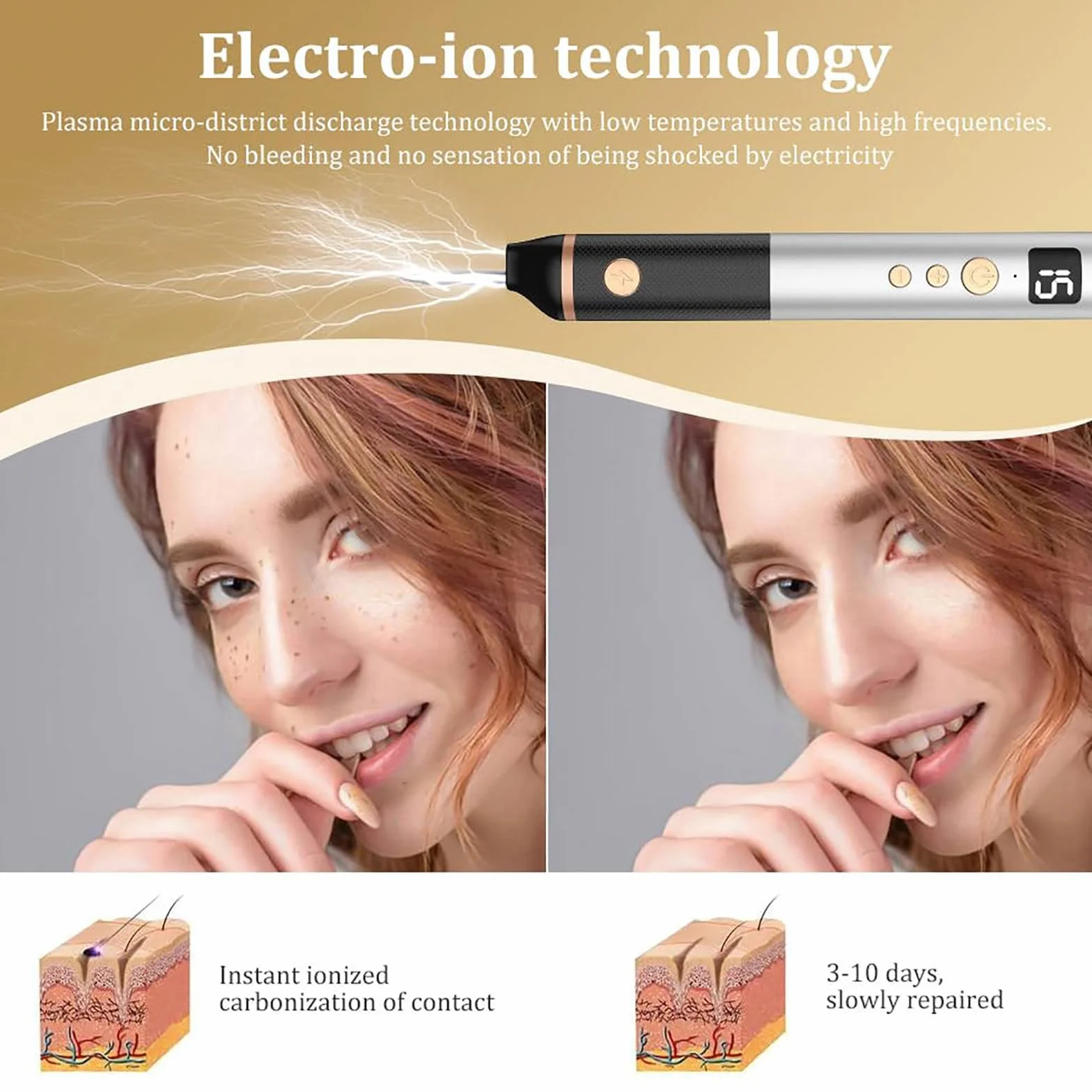 Stylo Plasma à 15 Niveaux pour Éliminer Acrochordons, Taches, Grains de Beauté, Verrues