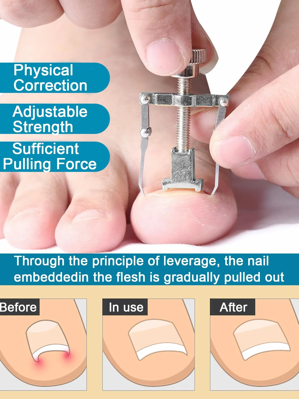 Kit Ongle Incarné Professionnel Acier Inoxydable Pedicure Correction
