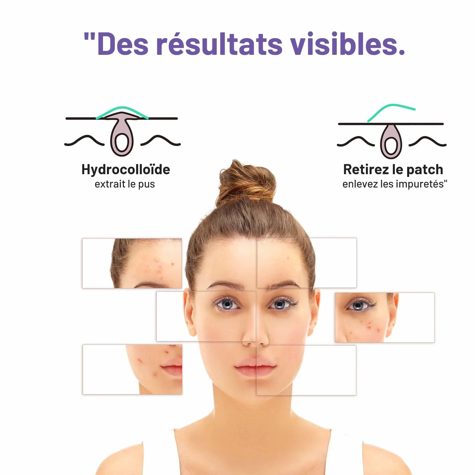 Patchs bouton ACOTYE 32pcs, pimple patch à l'huile d'arbre à thé, acide salicylique et niacinamide