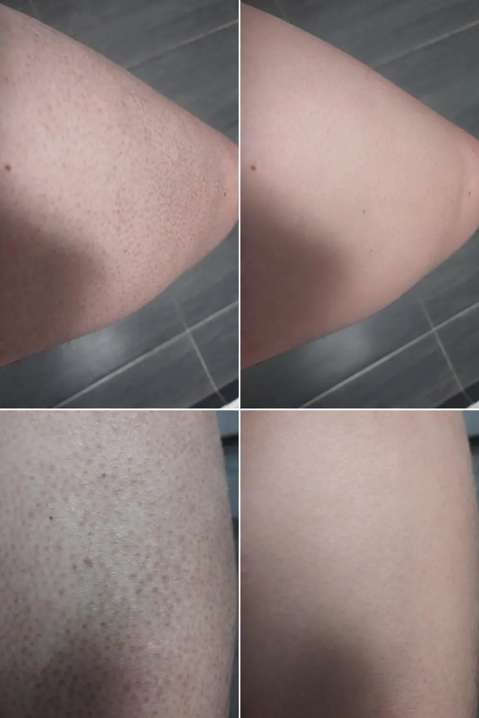 Spray kératose pilaire acide salicylique acide glycolique glycérine panthénol
