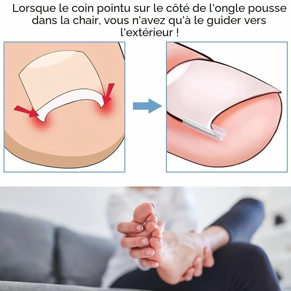 Ensemble Correcteur d'Ongles Incarnés 50 Bandes Sans Douleur Kit Outils