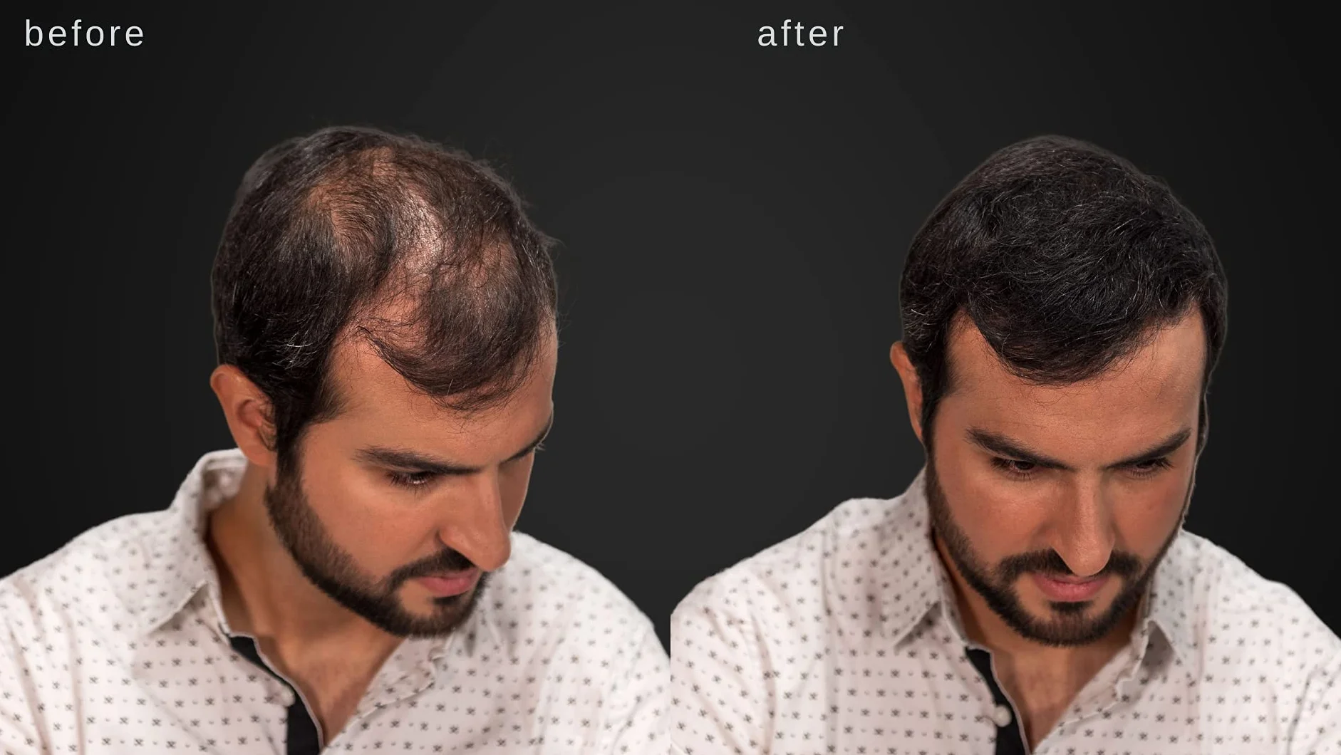 Hypoallergénique fibres épaississantes cheveux Marron foncé testé dermatologues