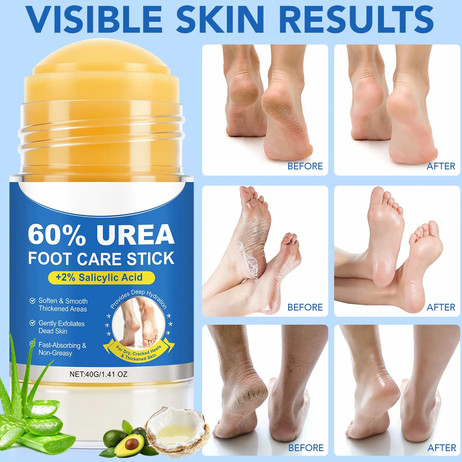 Urea Cream 60 Percent for Feet, Crème Réparatrice pour Peaux Très Sèches et Rugueuses (1PC)